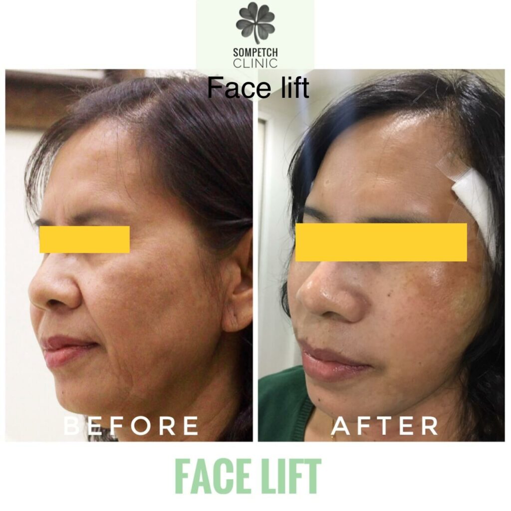 Before&After immediately of Facelift with Advance and best technique. Short incision. No downtime. Very little swelling(2-3 days). Amazing & immediate results. This procedure takes 1.5 hours under local anesthesia.